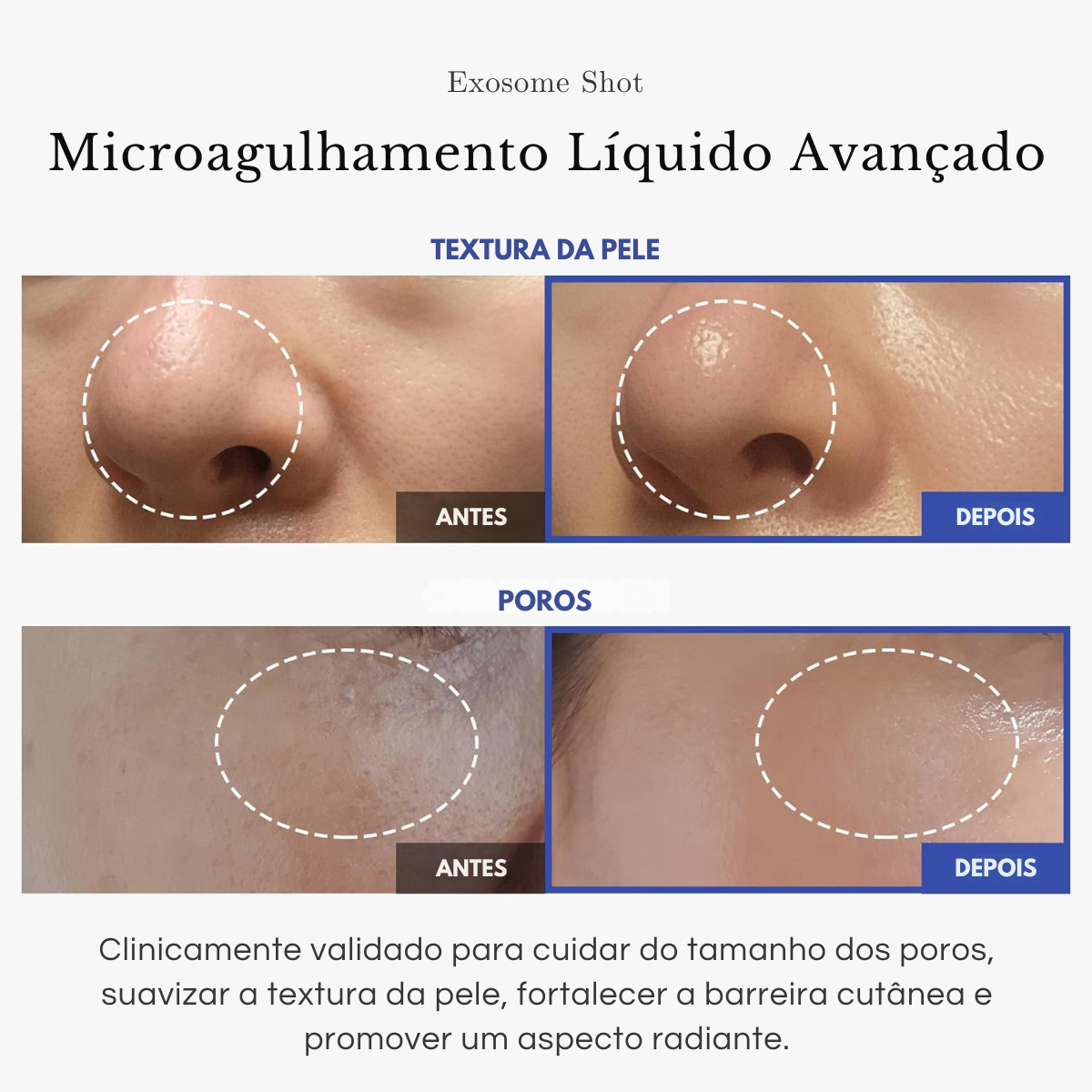 EXOSOMES HOT * liquid microneedling